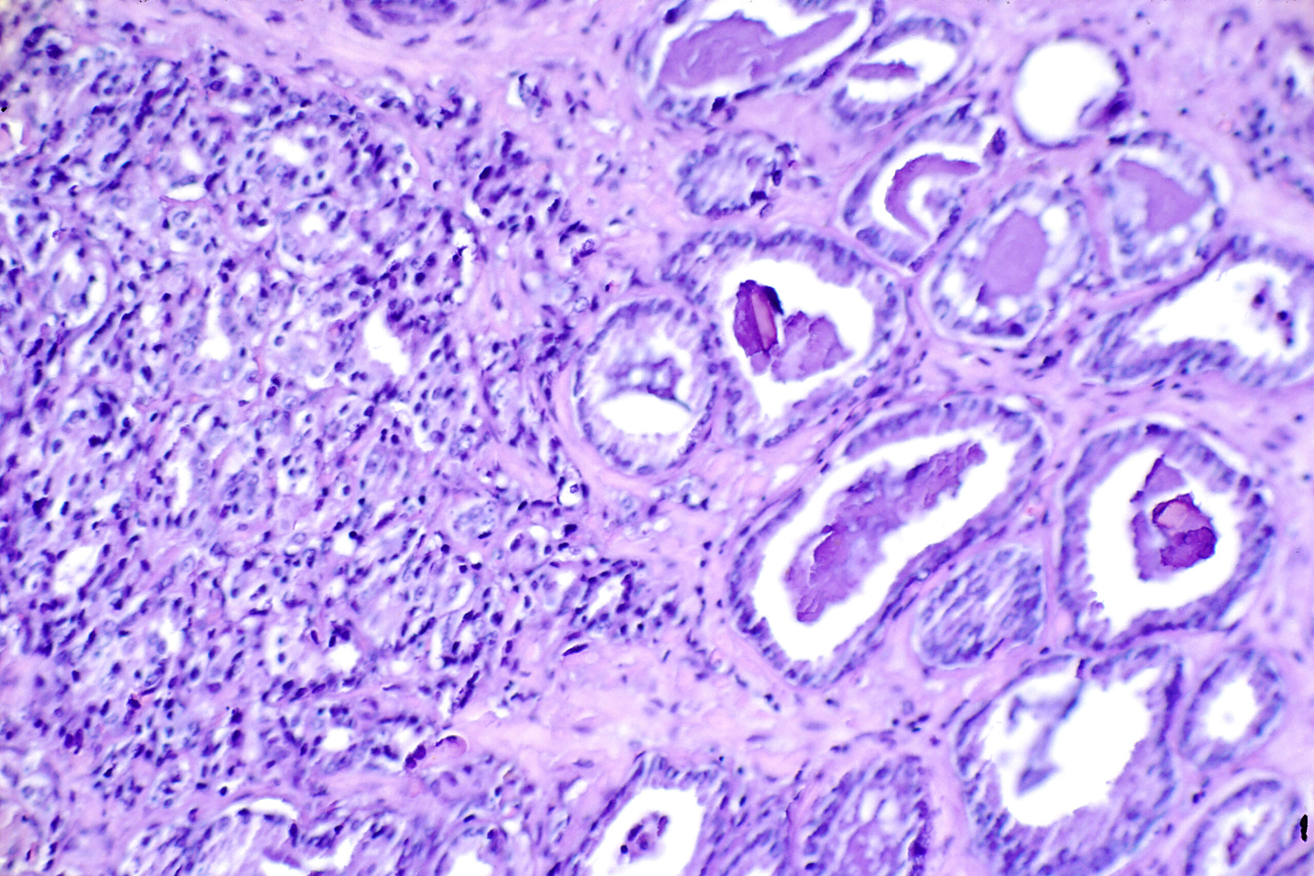 This is a picture of cancer cells under a slide